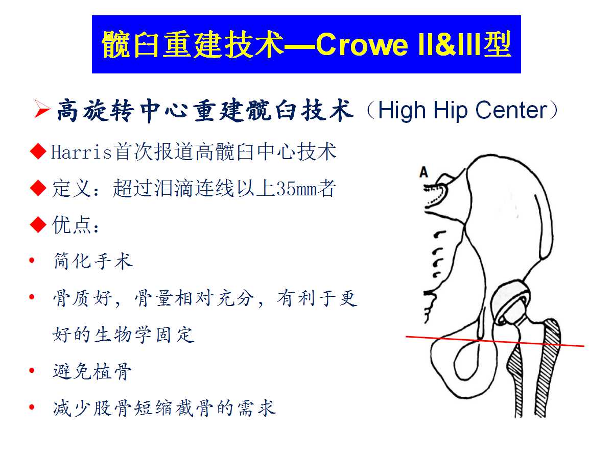 成人DDH的全髋关节置换技术