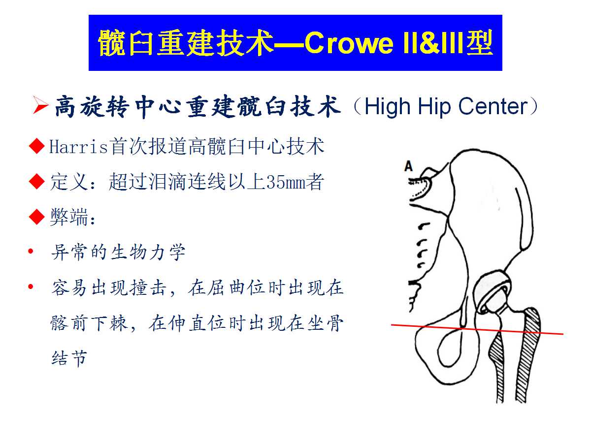 成人DDH的全髋关节置换技术