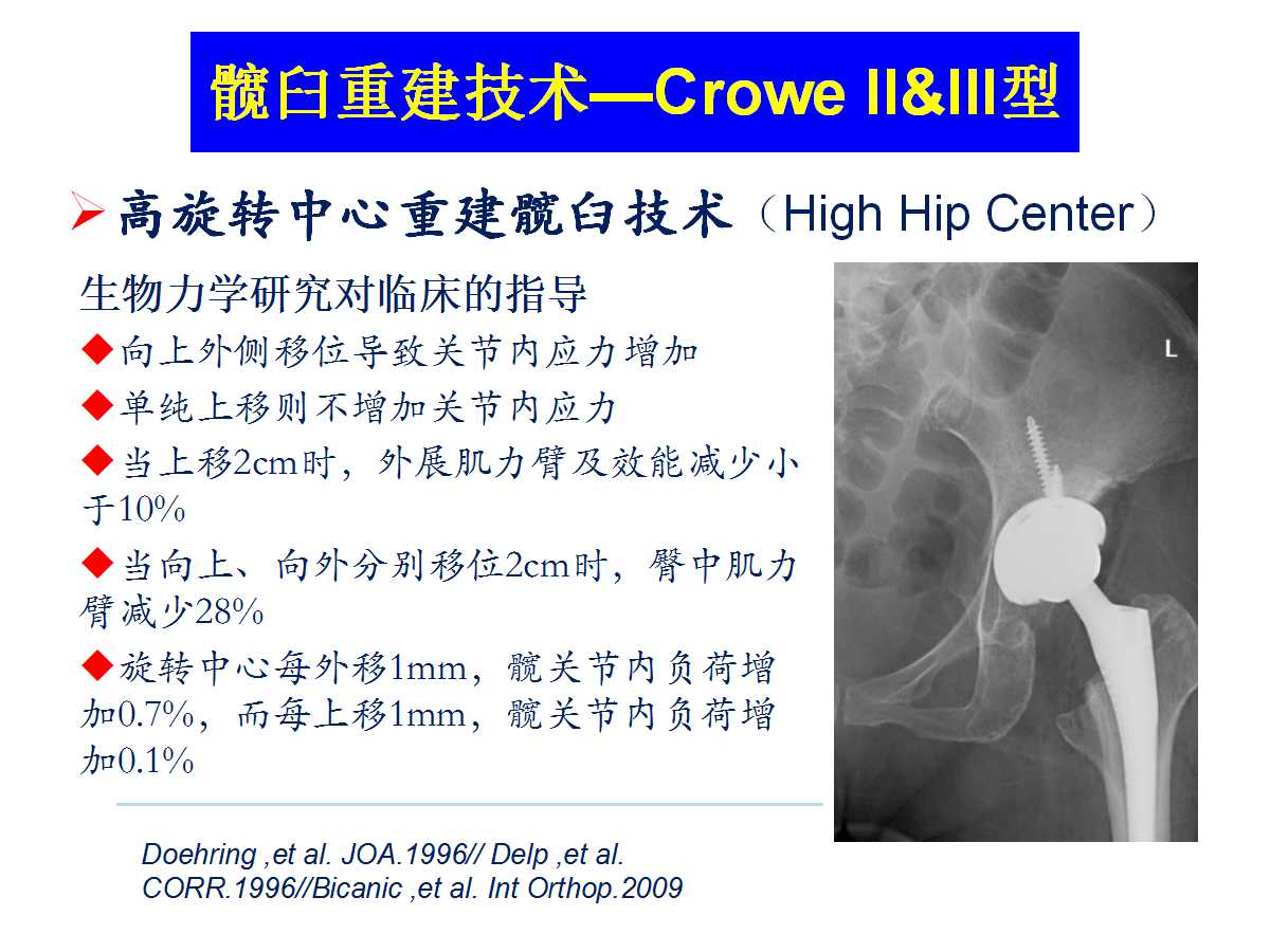 成人DDH的全髋关节置换技术