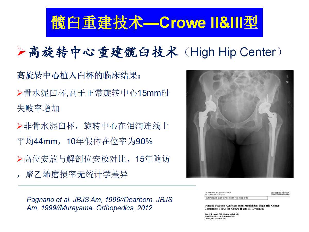 成人DDH的全髋关节置换技术