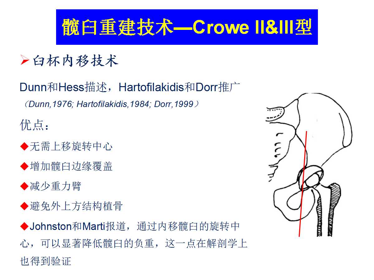 成人DDH的全髋关节置换技术