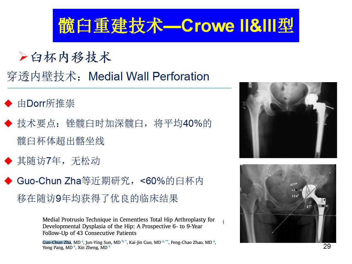 成人DDH的全髋关节置换技术