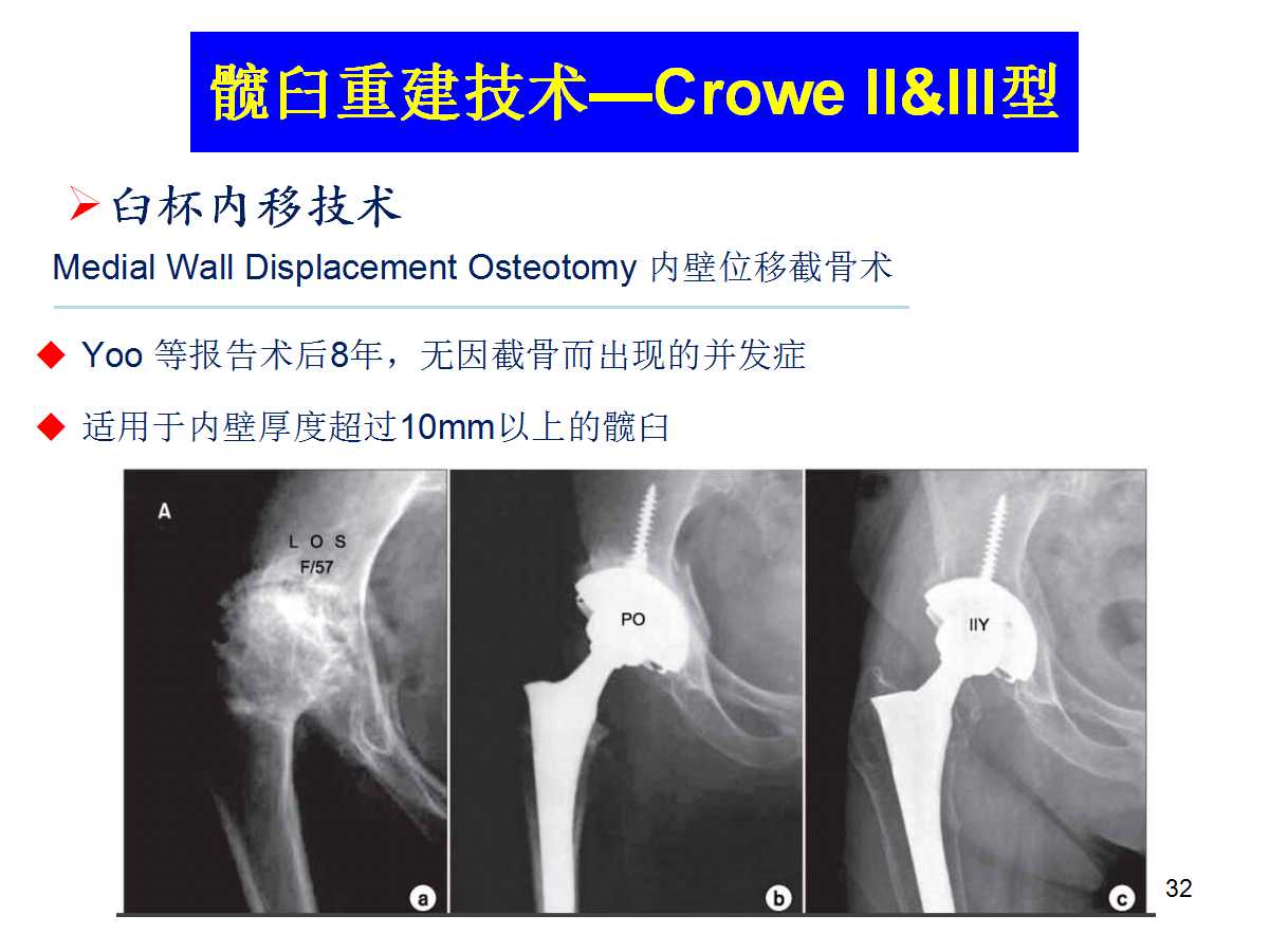 成人DDH的全髋关节置换技术