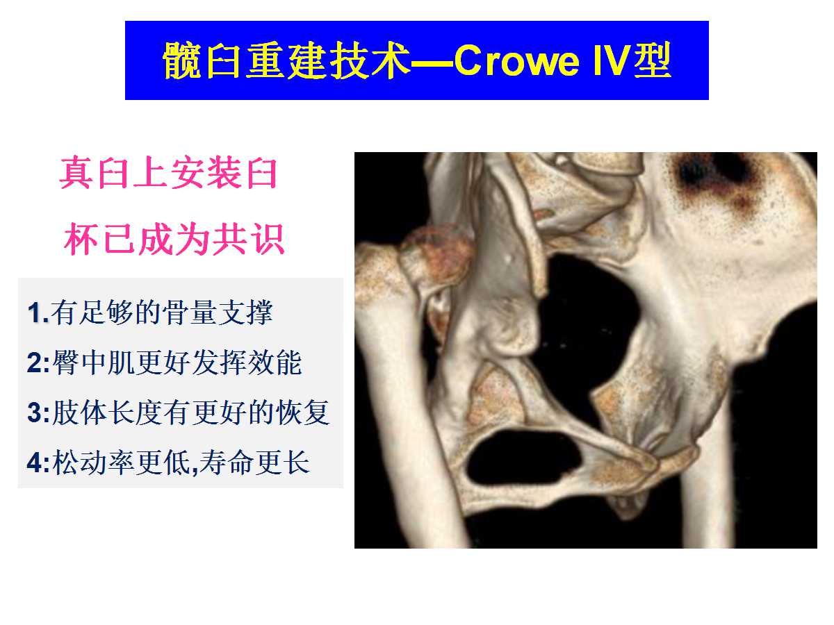 成人DDH的全髋关节置换技术