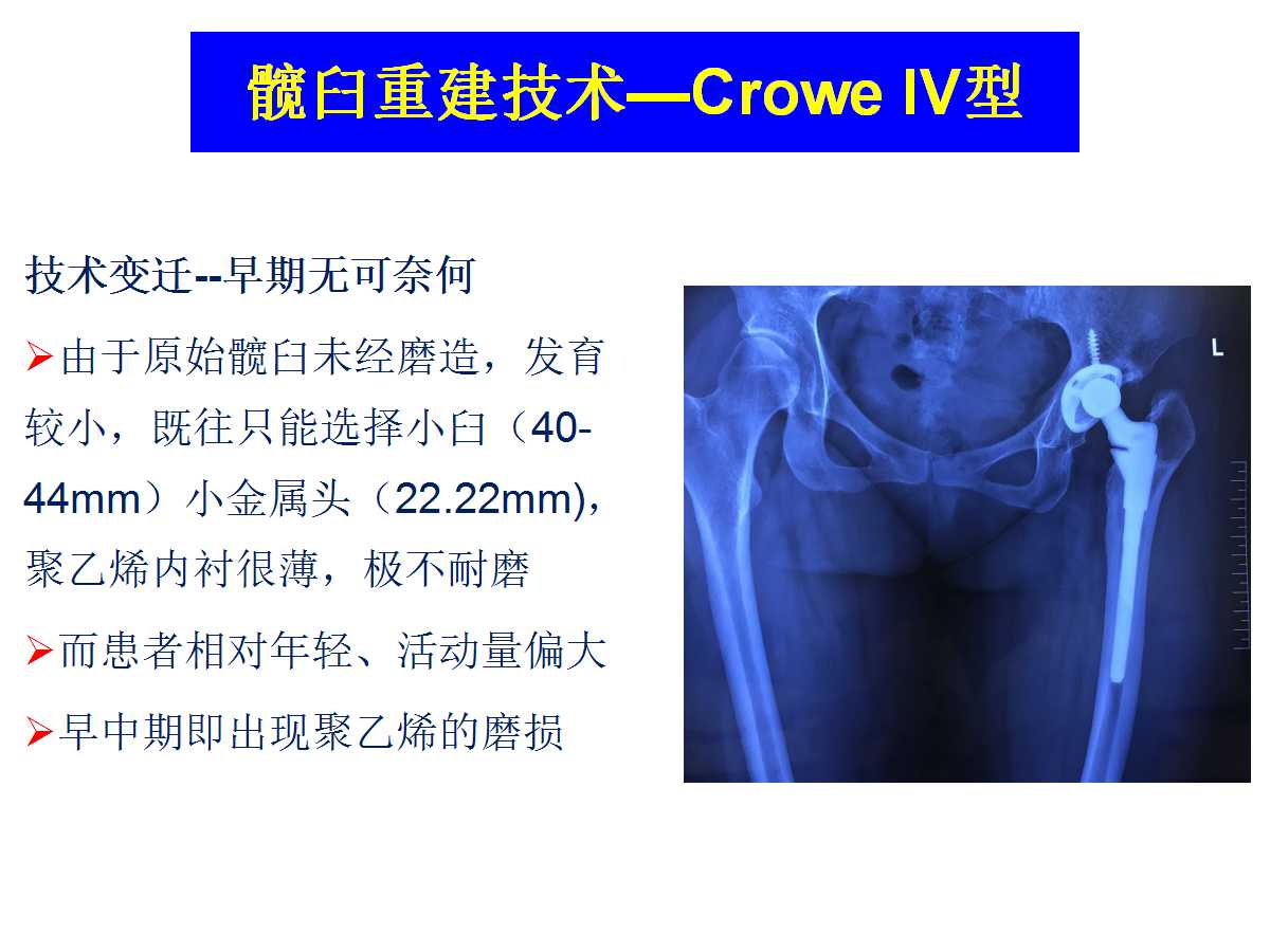 成人DDH的全髋关节置换技术