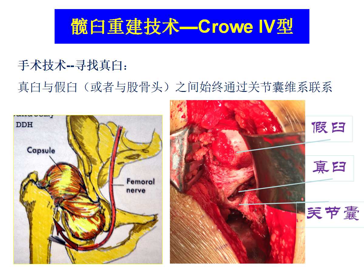 成人DDH的全髋关节置换技术