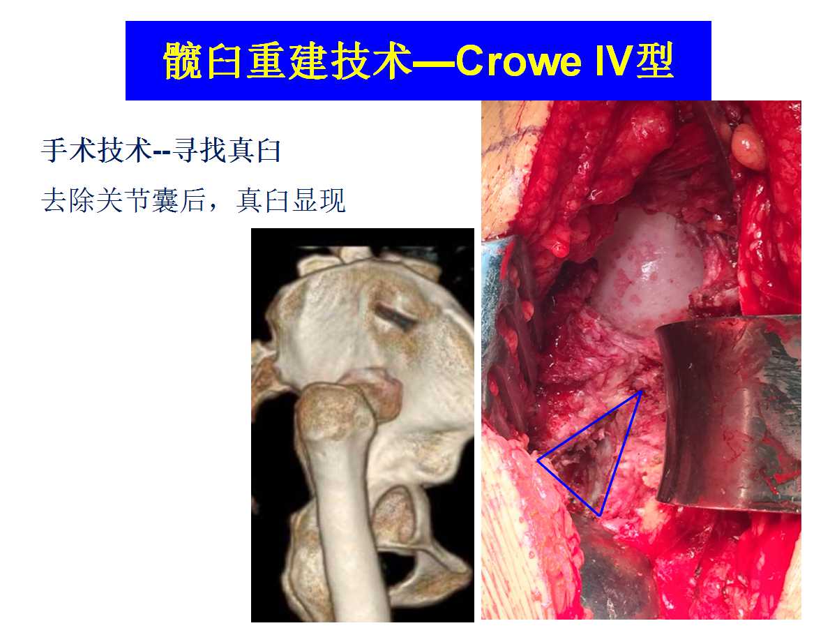 成人DDH的全髋关节置换技术