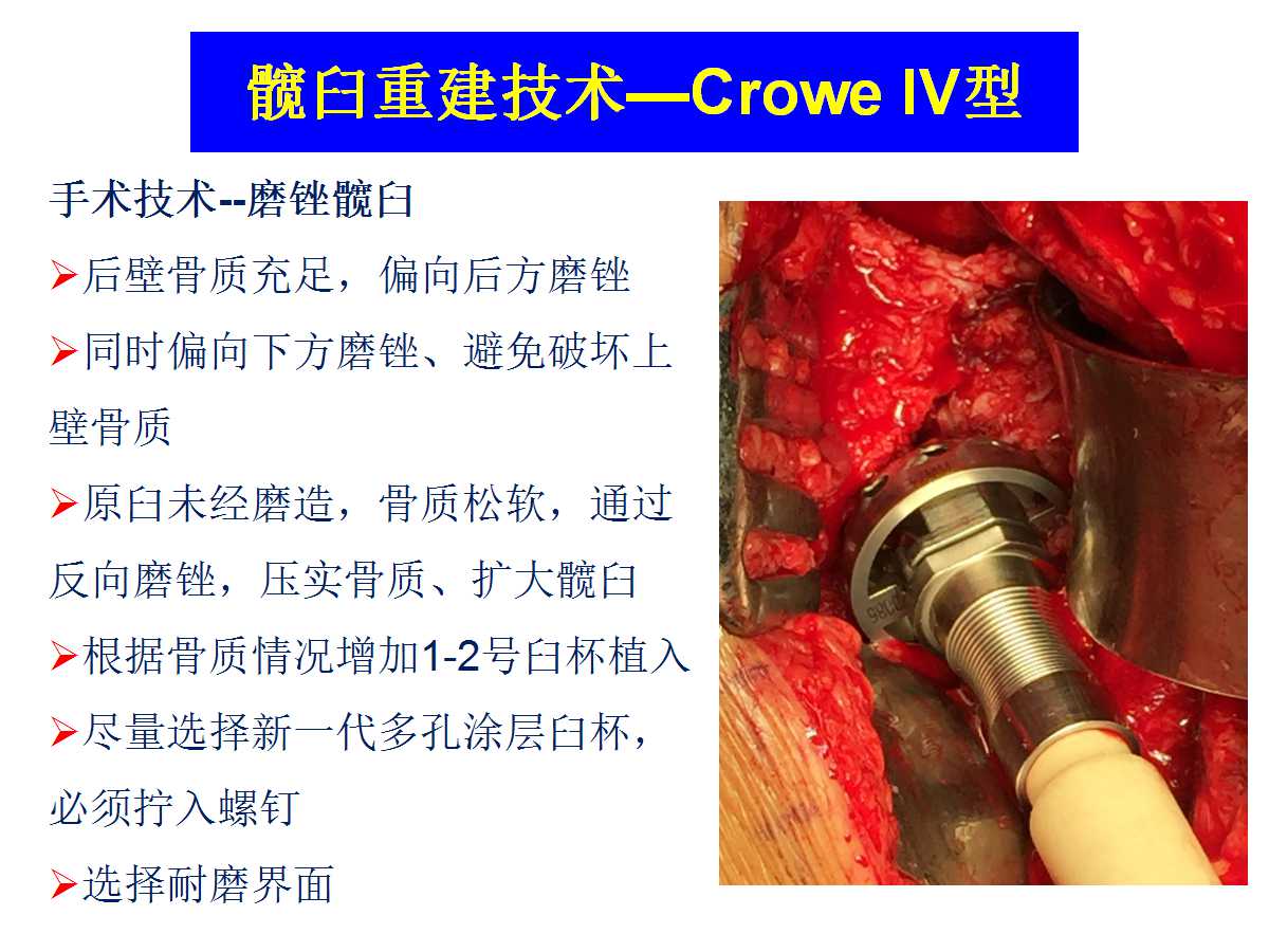 成人DDH的全髋关节置换技术