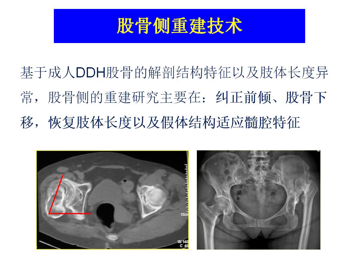 成人DDH的全髋关节置换技术