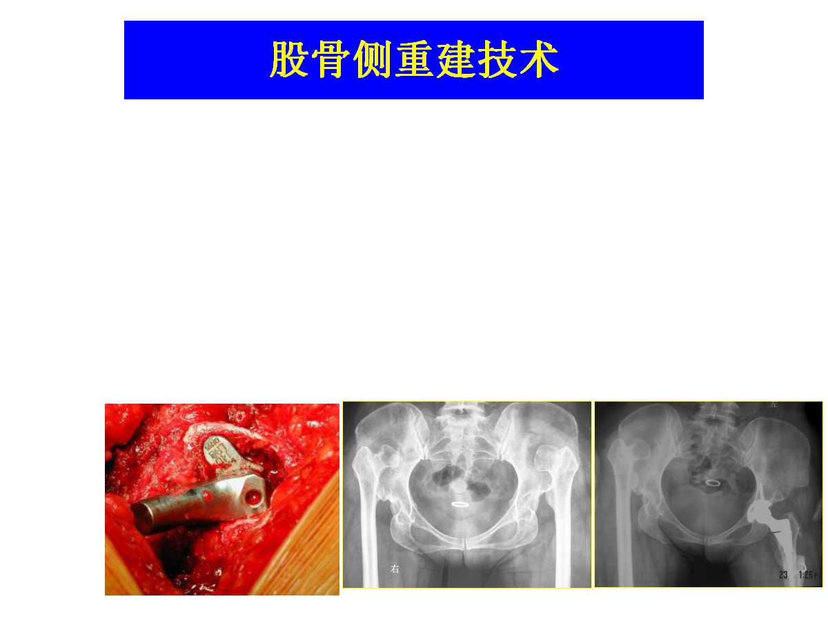 成人DDH的全髋关节置换技术