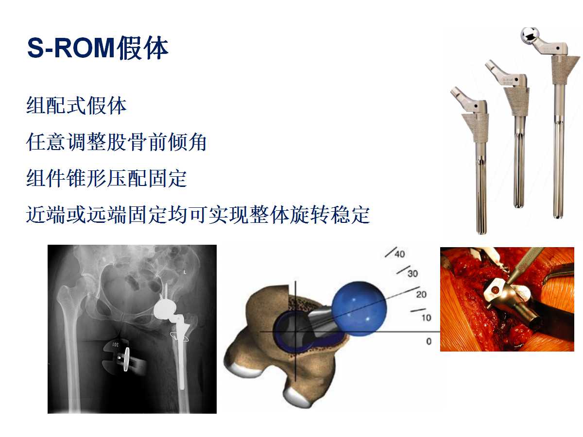 成人DDH的全髋关节置换技术