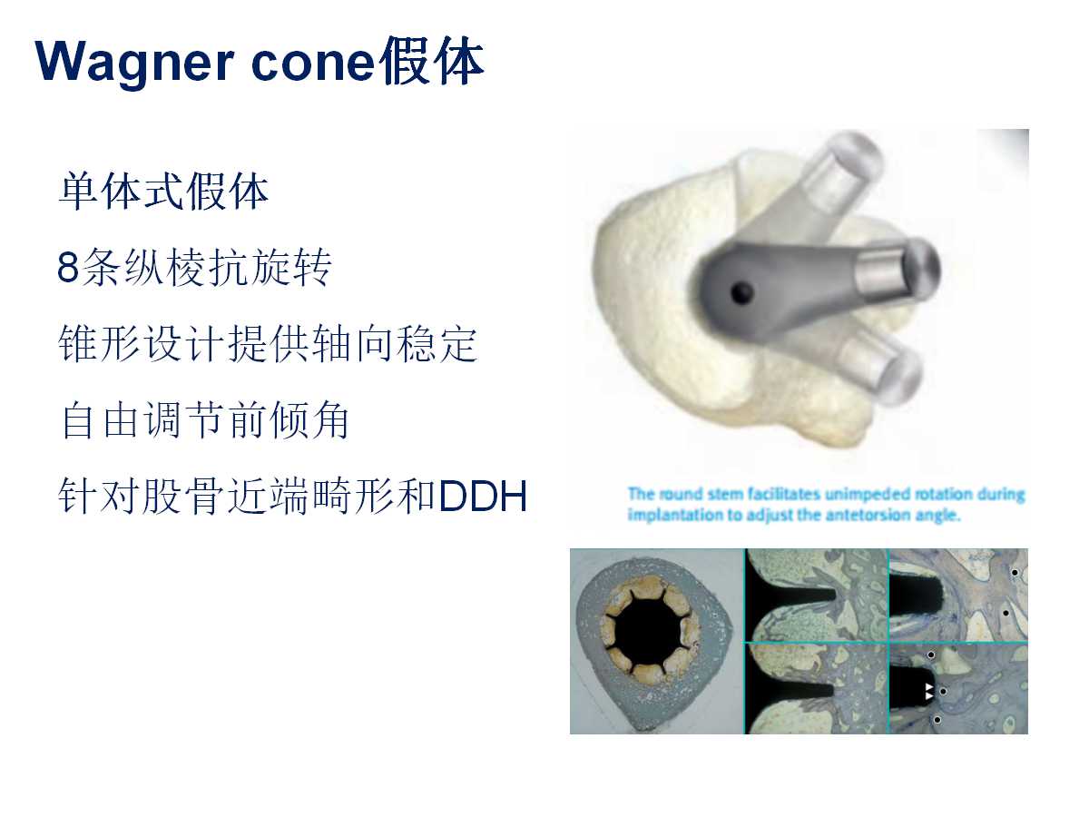 成人DDH的全髋关节置换技术