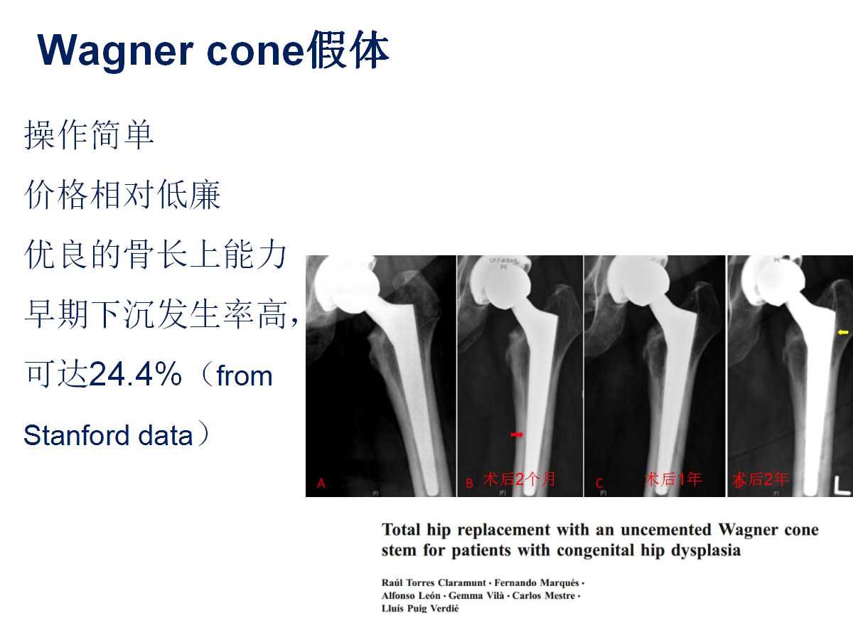 成人DDH的全髋关节置换技术