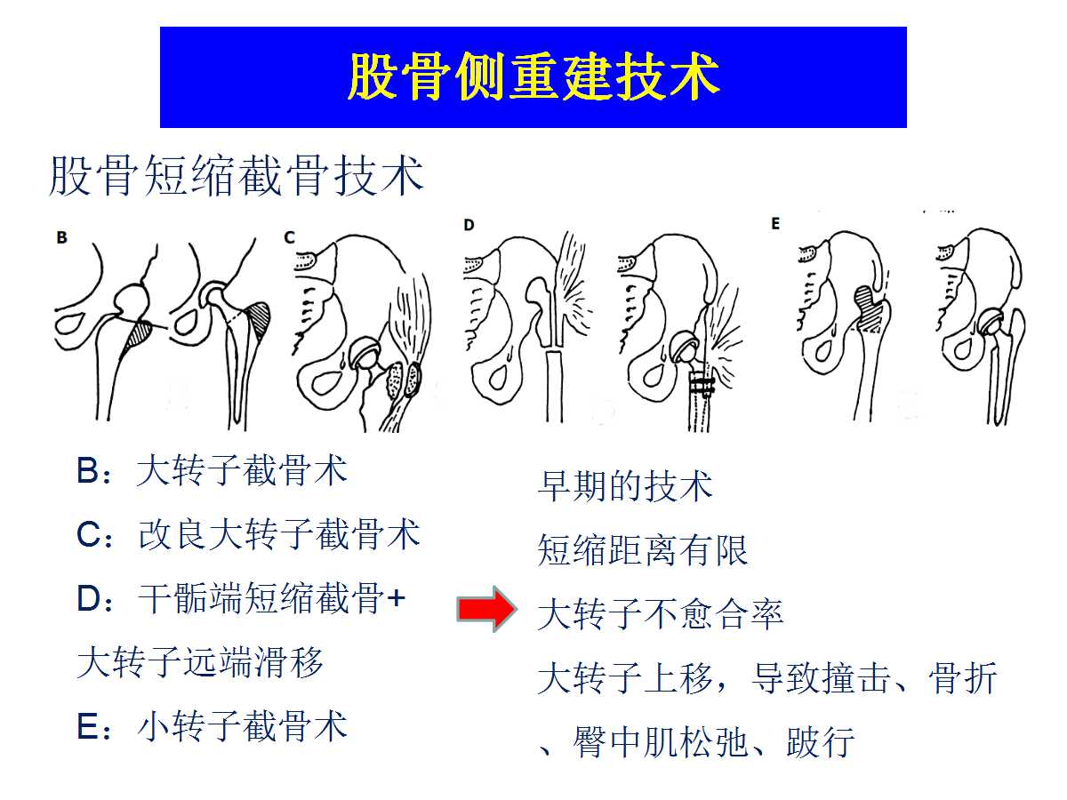 成人DDH的全髋关节置换技术