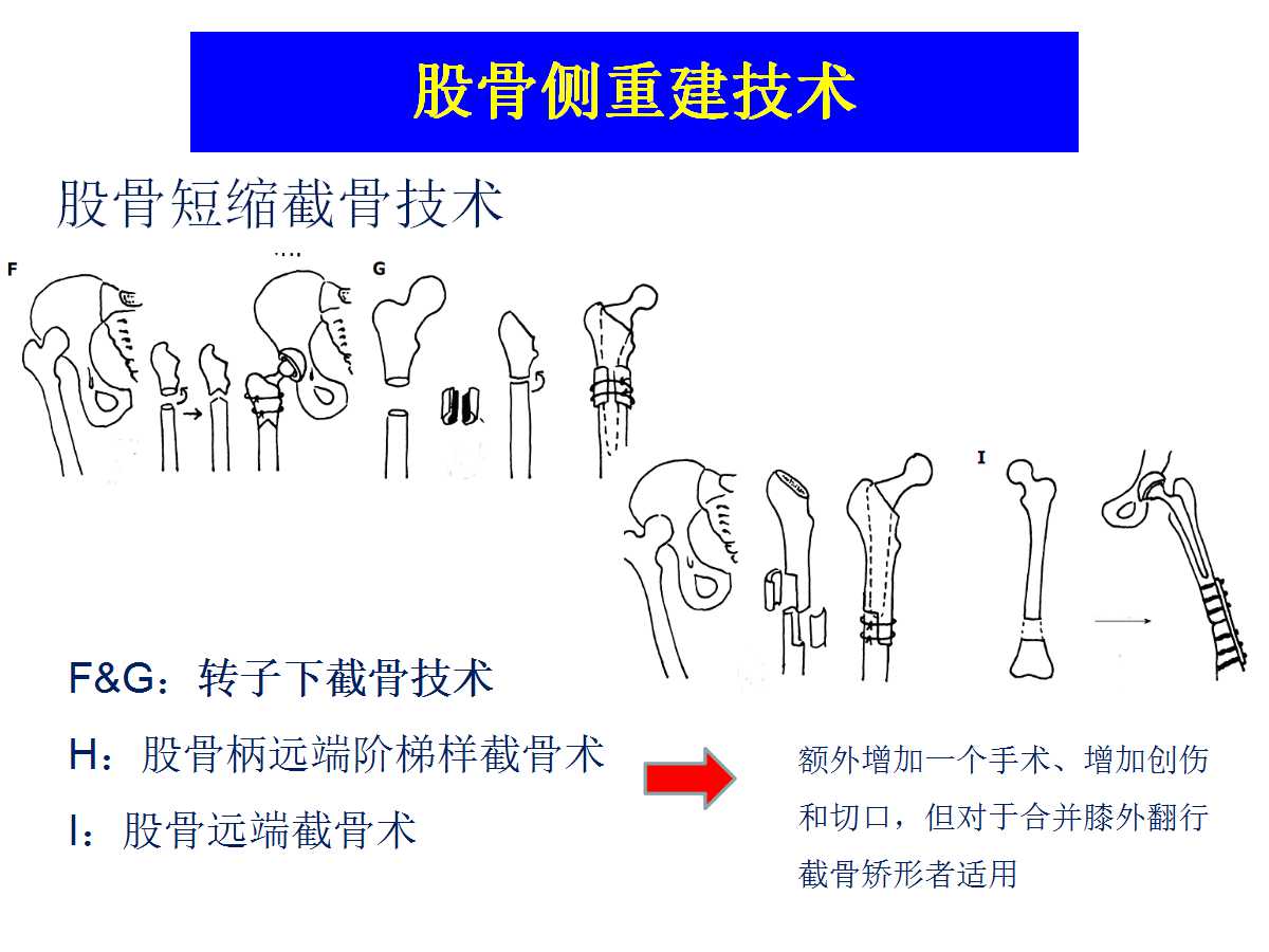 成人DDH的全髋关节置换技术