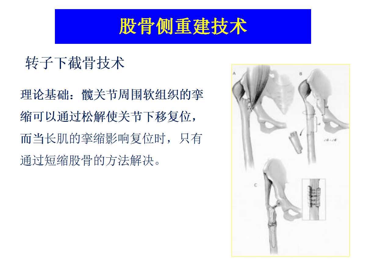 成人DDH的全髋关节置换技术