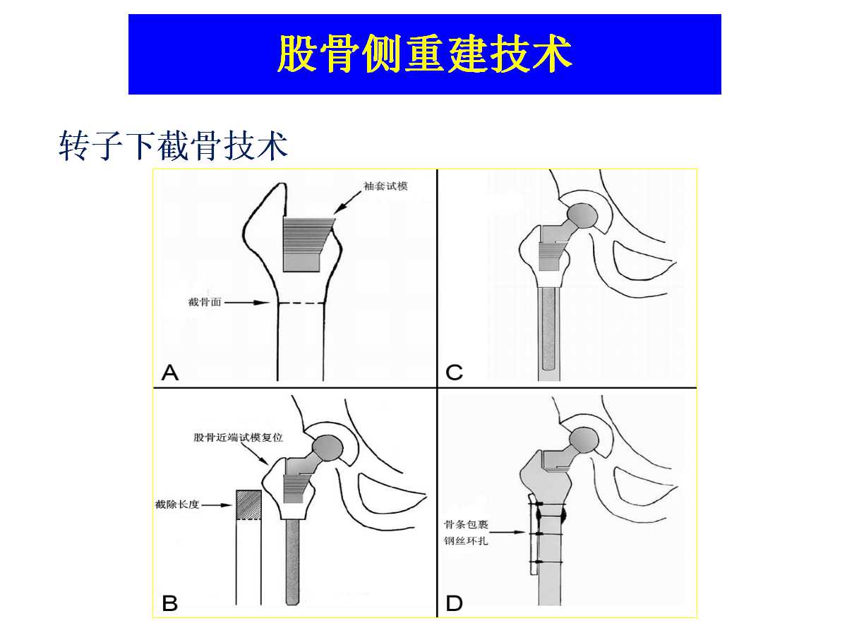 成人DDH的全髋关节置换技术