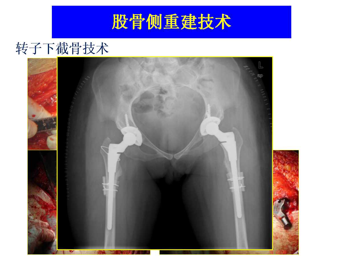 成人DDH的全髋关节置换技术