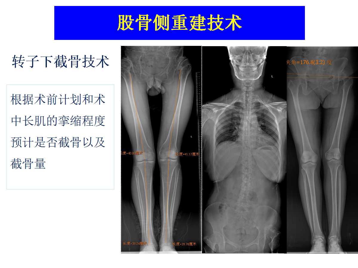 成人DDH的全髋关节置换技术