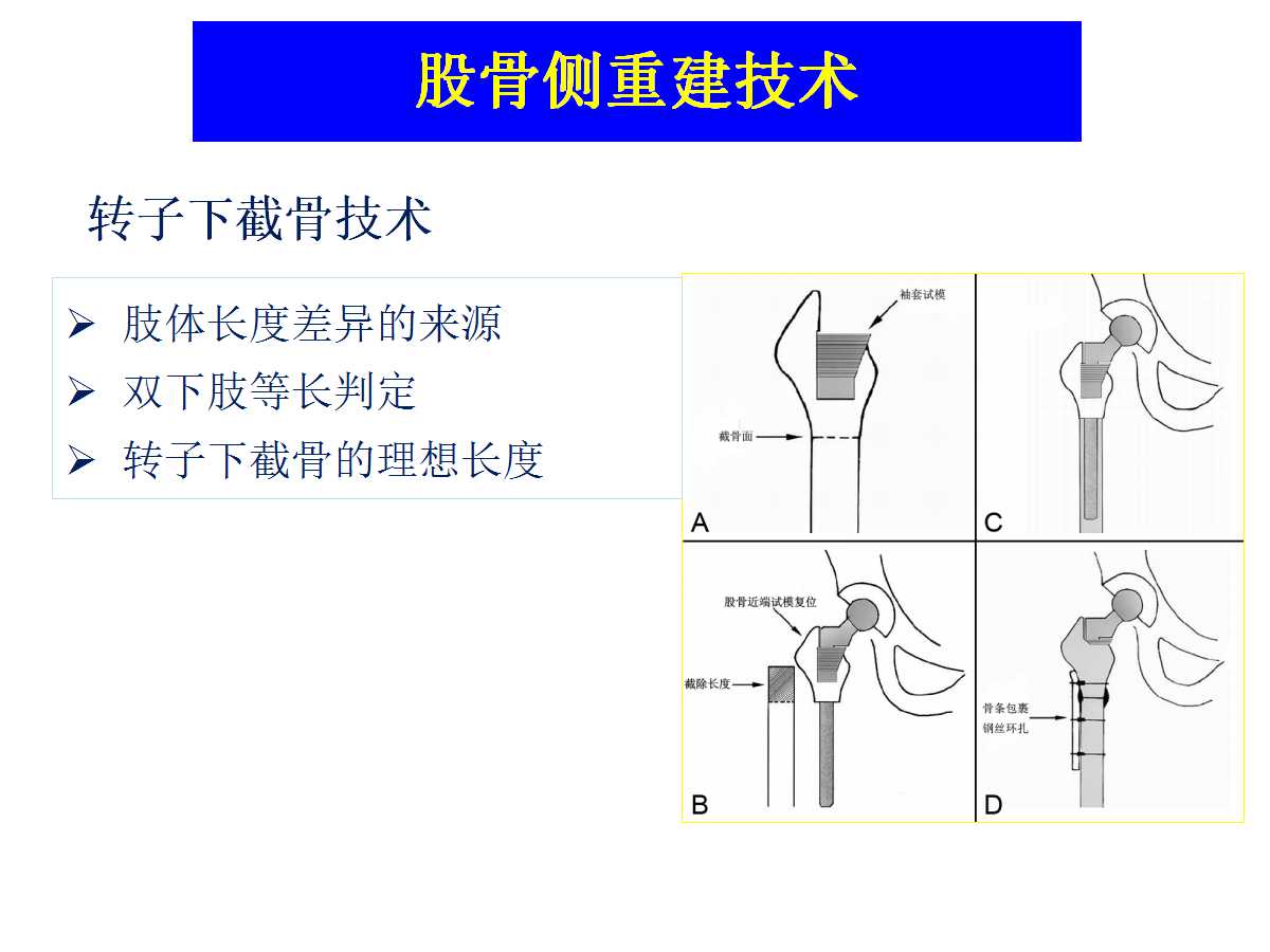 成人DDH的全髋关节置换技术