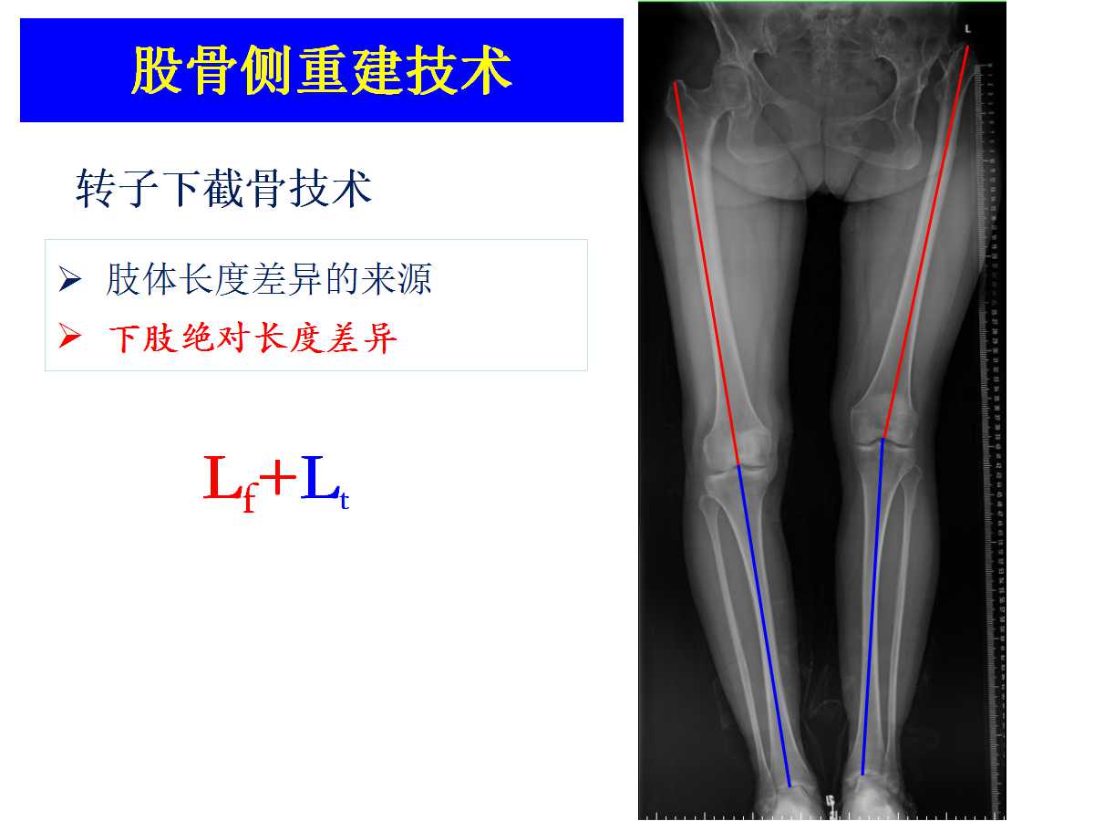 成人DDH的全髋关节置换技术