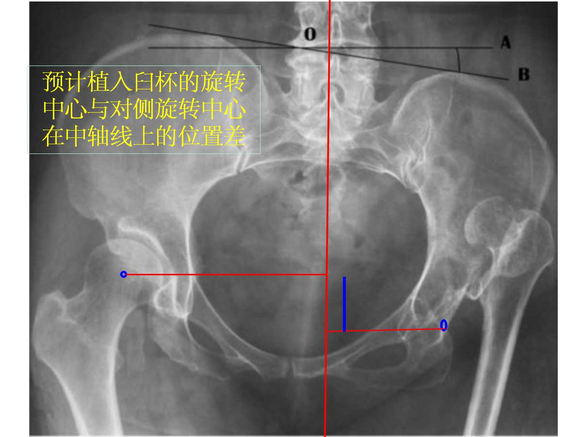 成人DDH的全髋关节置换技术