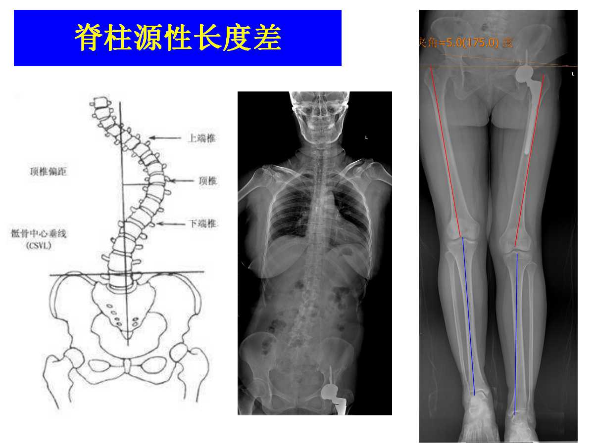 成人DDH的全髋关节置换技术