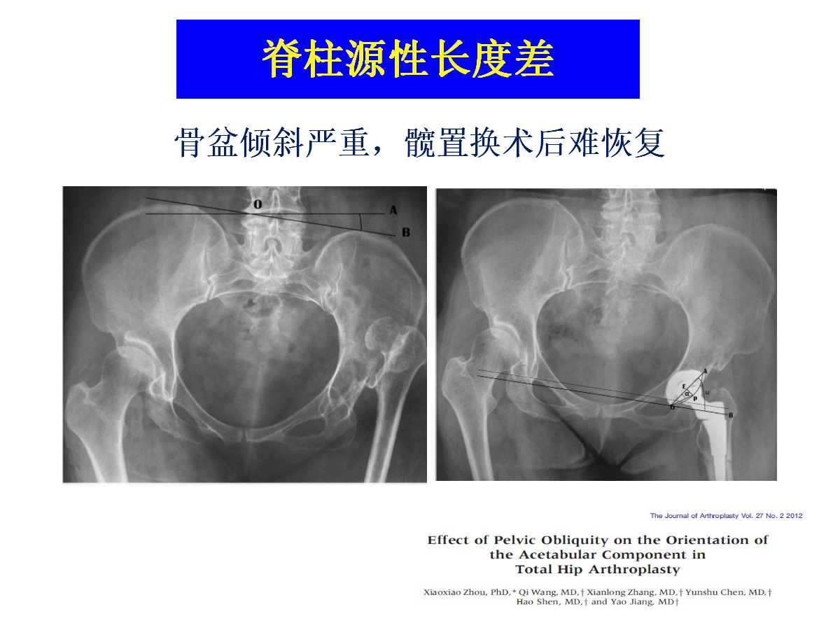 成人DDH的全髋关节置换技术