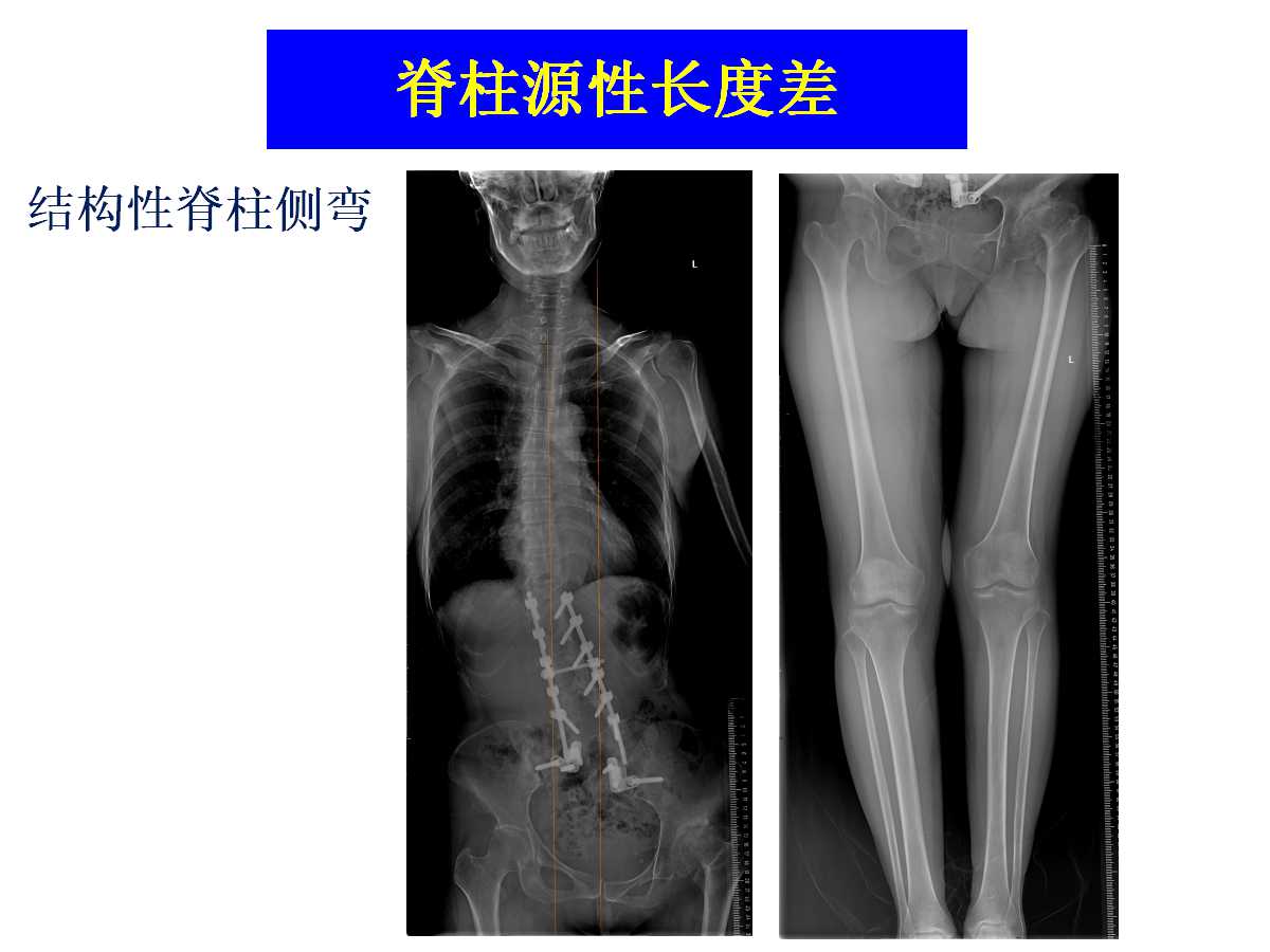 成人DDH的全髋关节置换技术