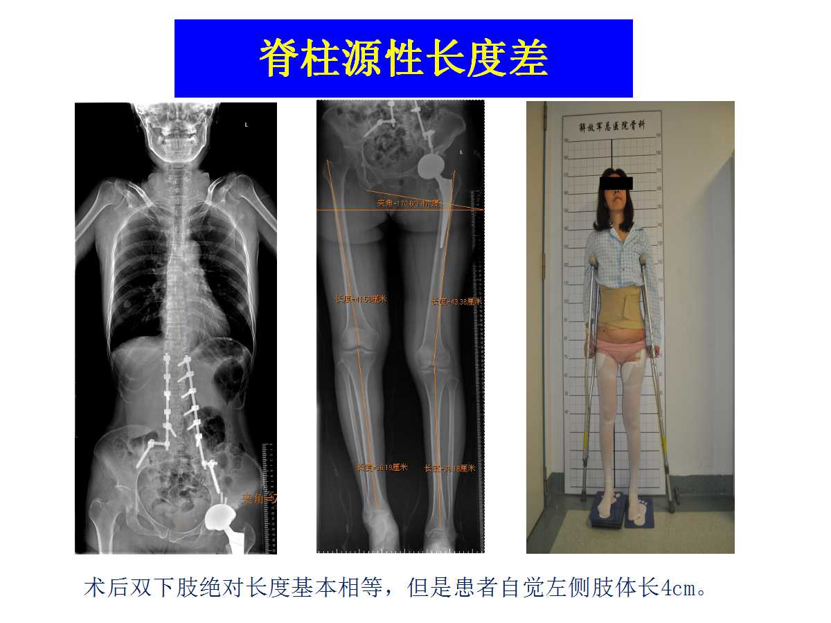 成人DDH的全髋关节置换技术