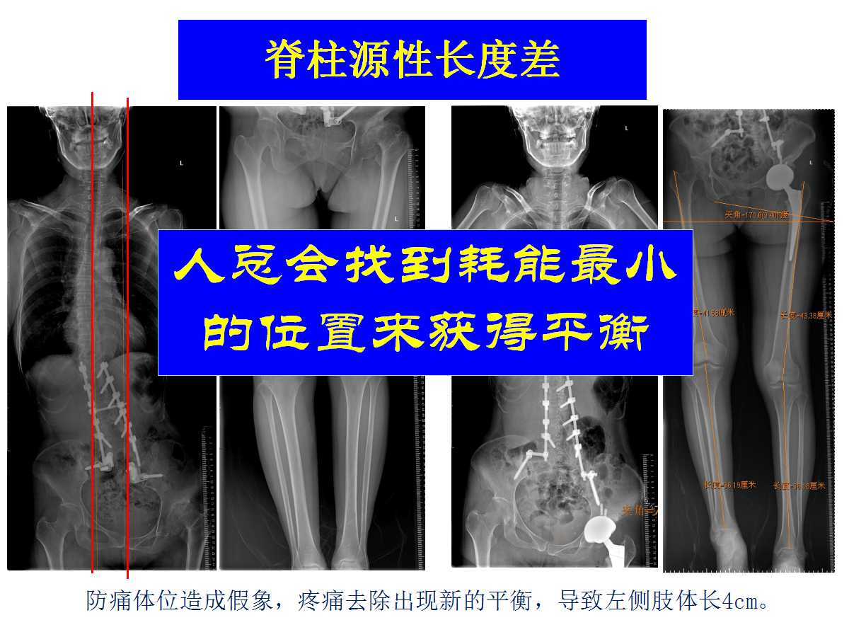 成人DDH的全髋关节置换技术