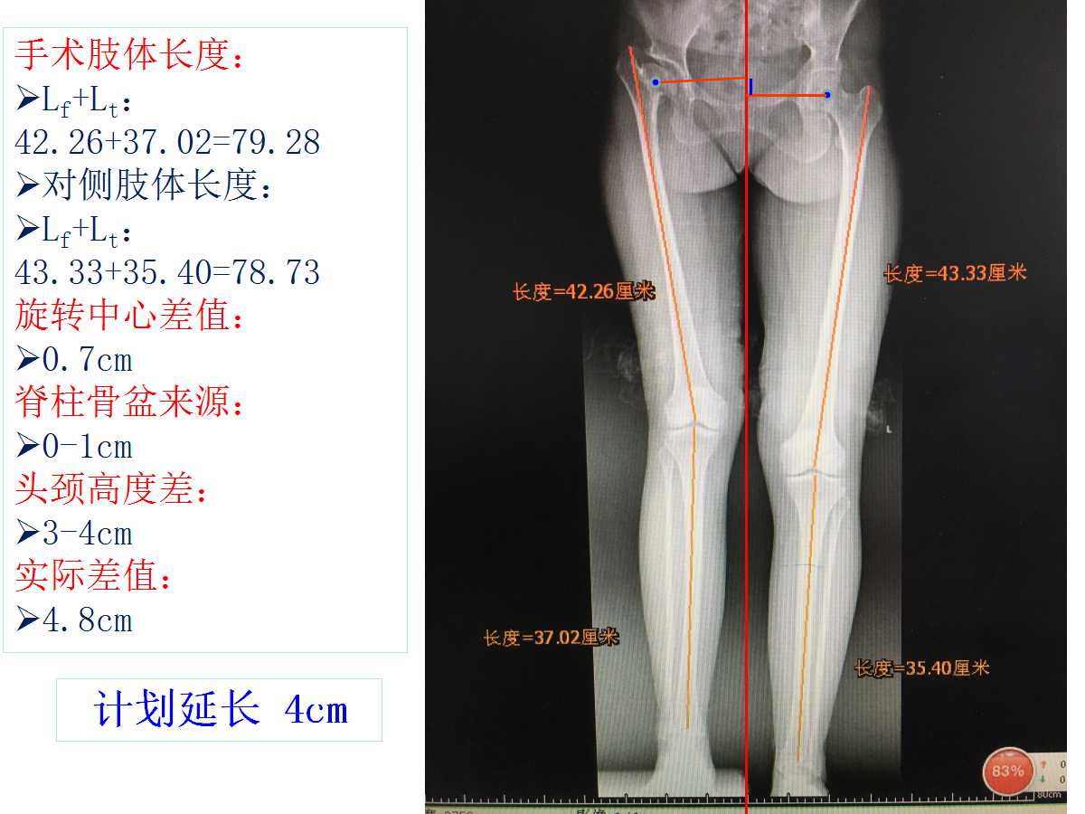 成人DDH的全髋关节置换技术