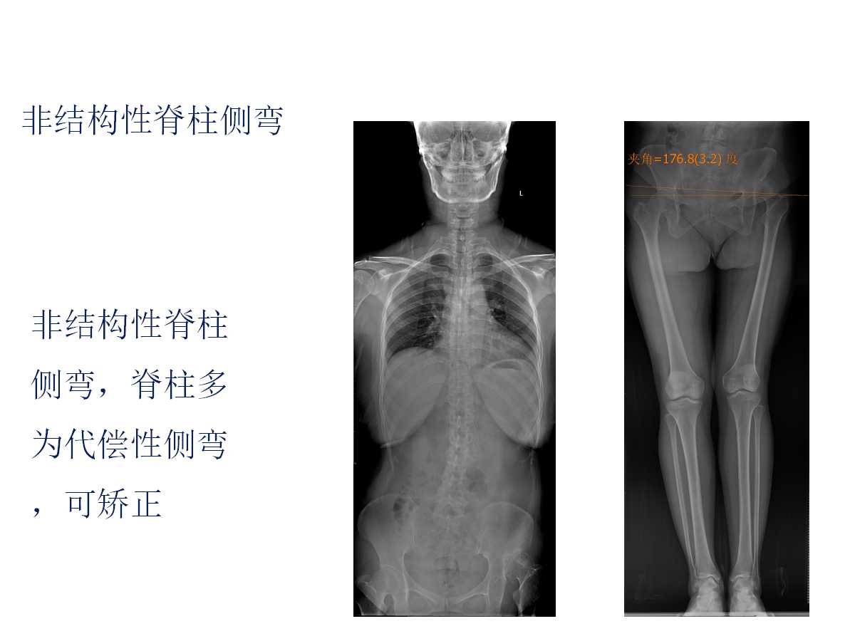 成人DDH的全髋关节置换技术