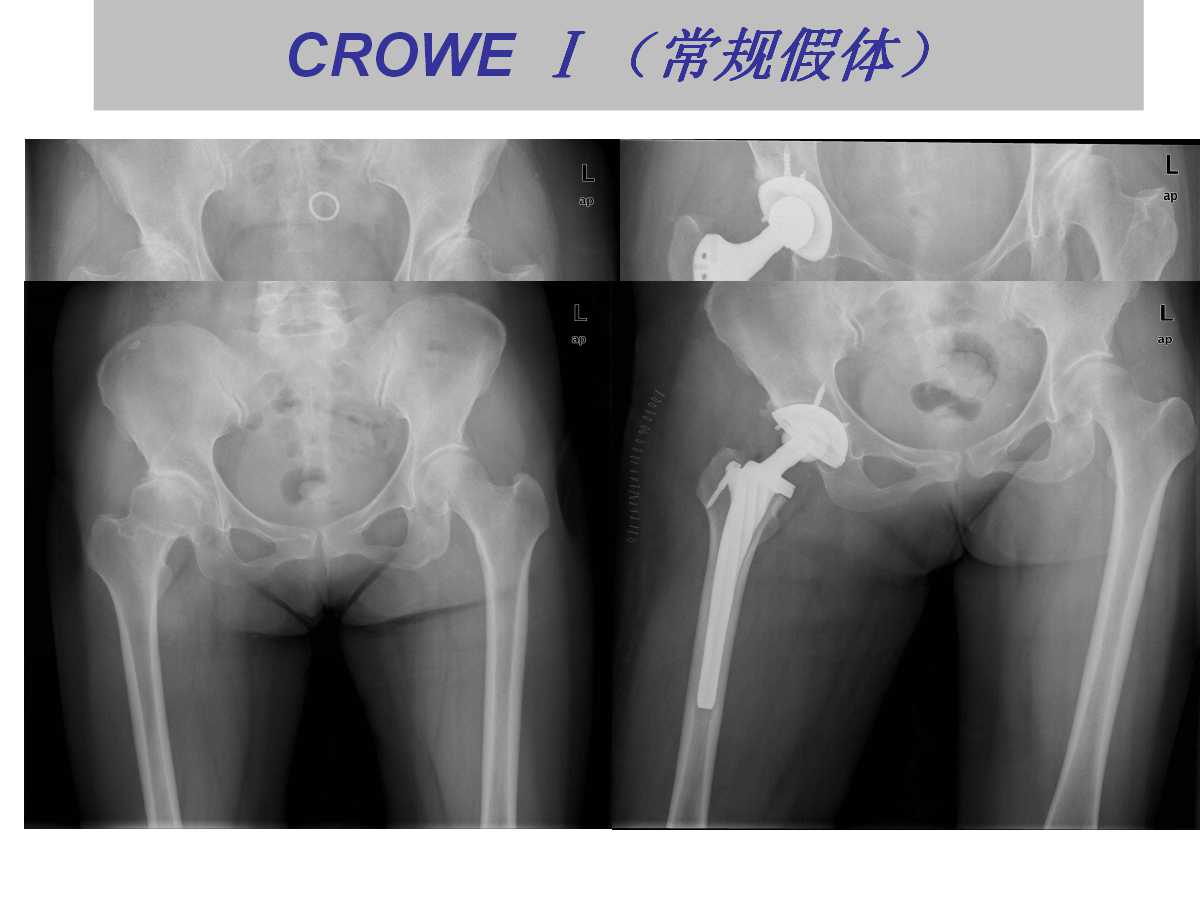 成人DDH的全髋关节置换技术