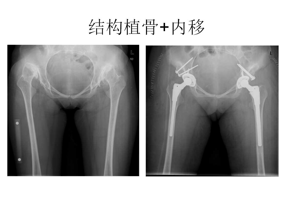 成人DDH的全髋关节置换技术