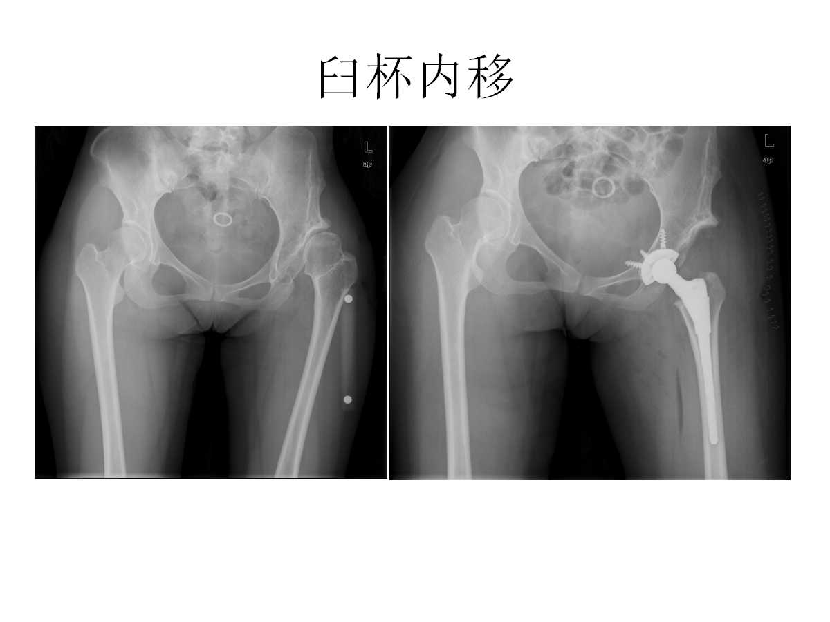 成人DDH的全髋关节置换技术