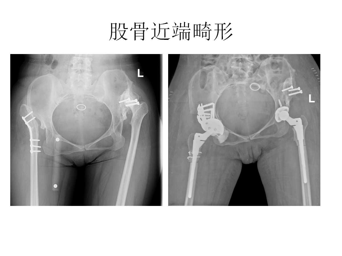 成人DDH的全髋关节置换技术