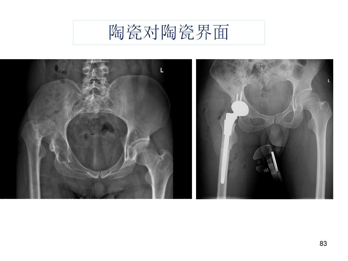 成人DDH的全髋关节置换技术