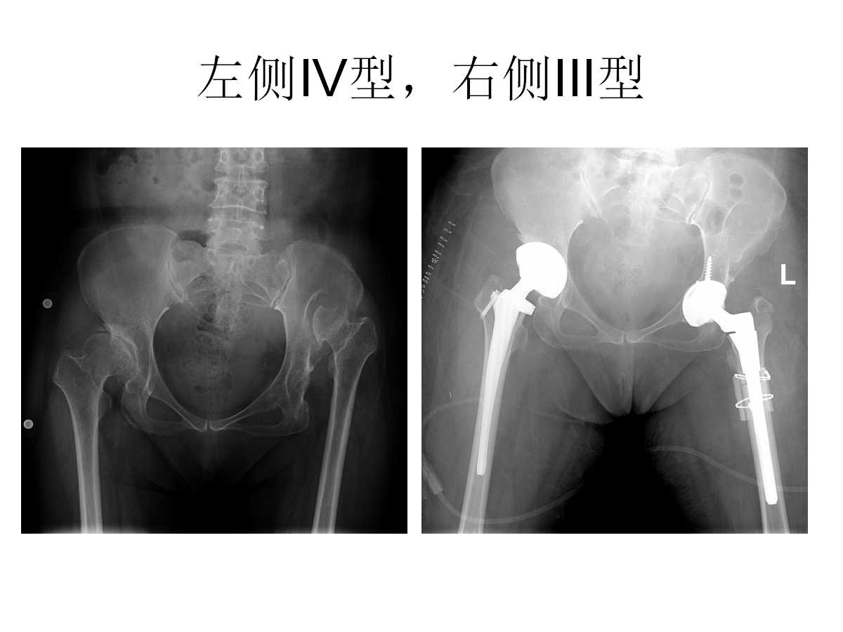 成人DDH的全髋关节置换技术