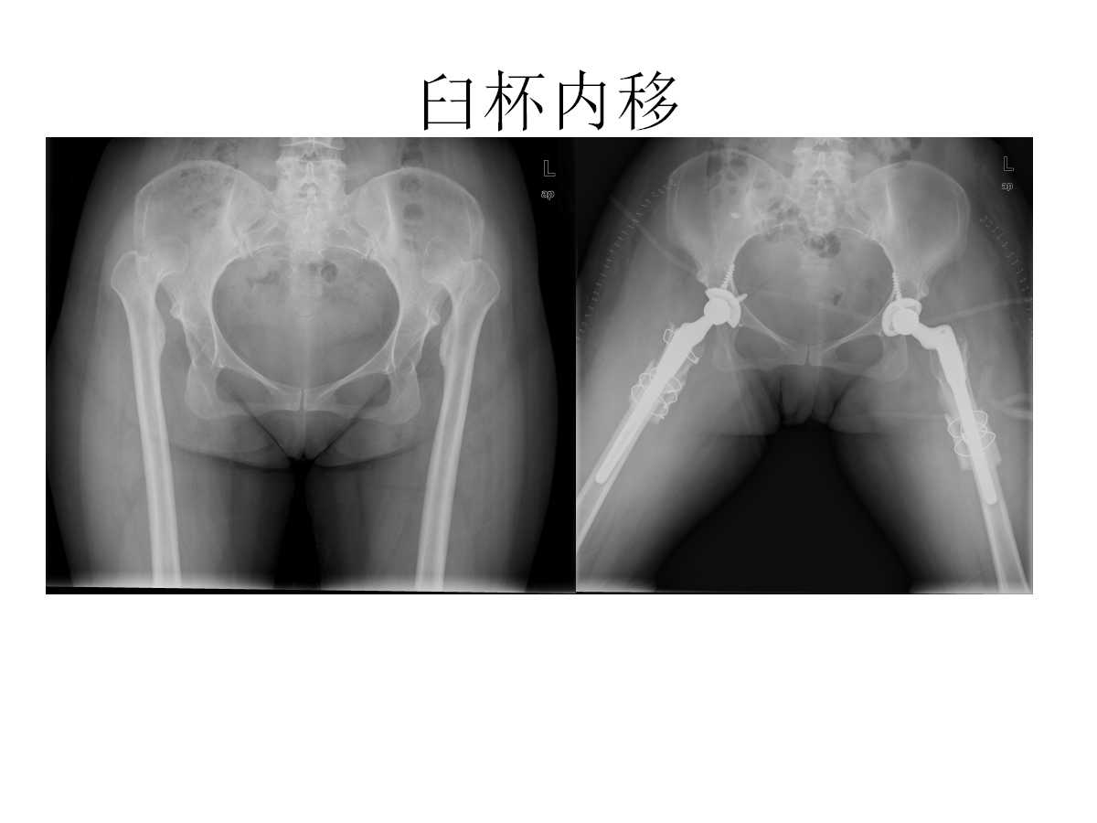 成人DDH的全髋关节置换技术