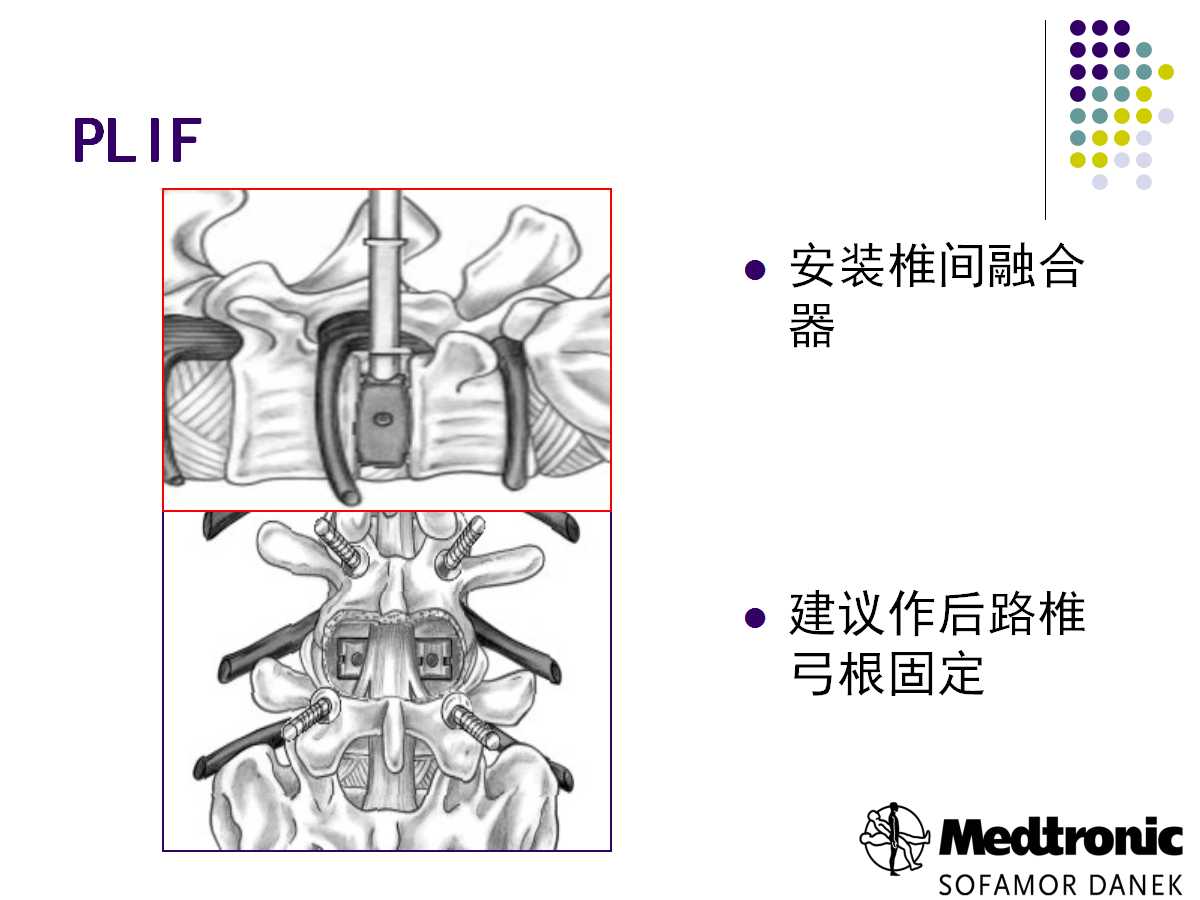 腰椎融合术的常用术式及其应用