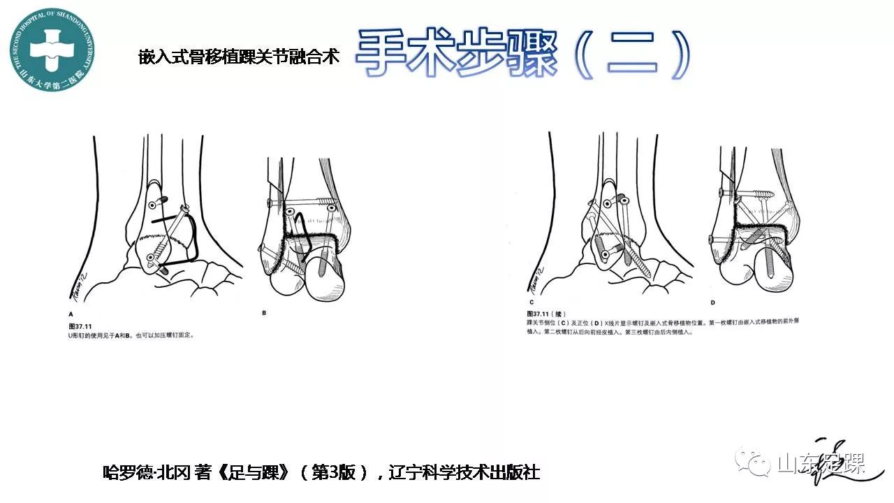 踝关节融合术的基本手术策略