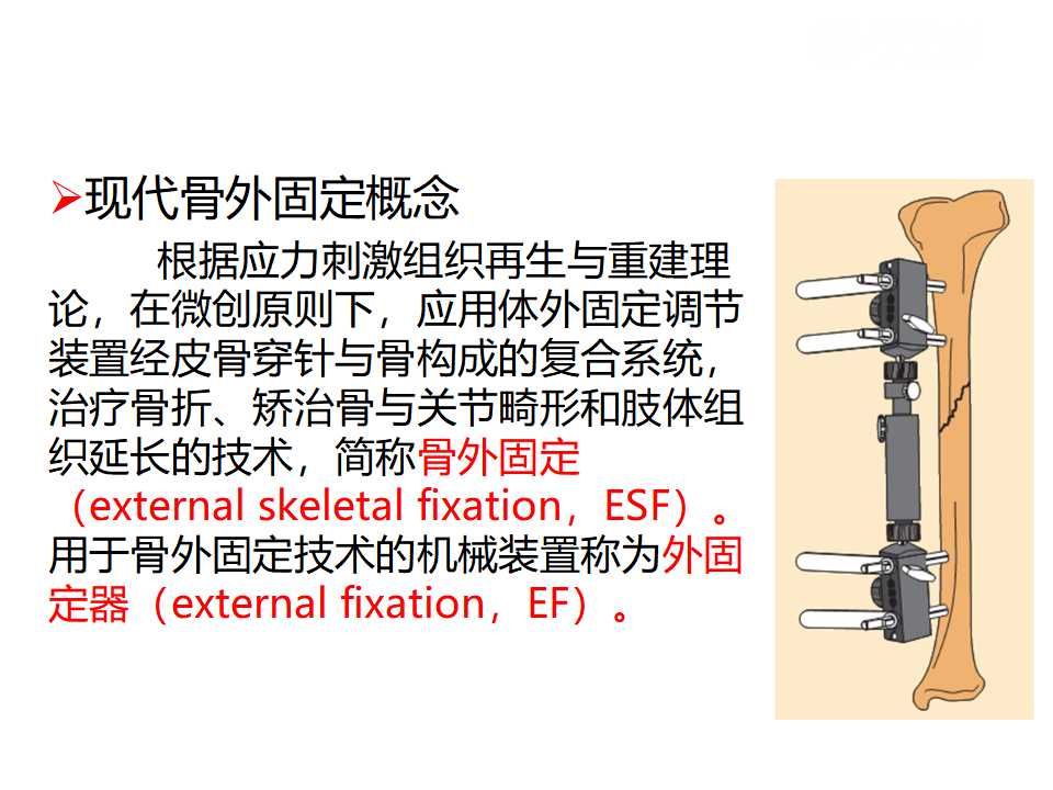 骨科常见的外固定架及其临床应用