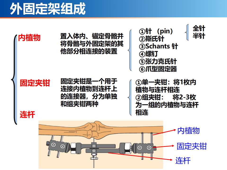 骨科常见的外固定架及其临床应用