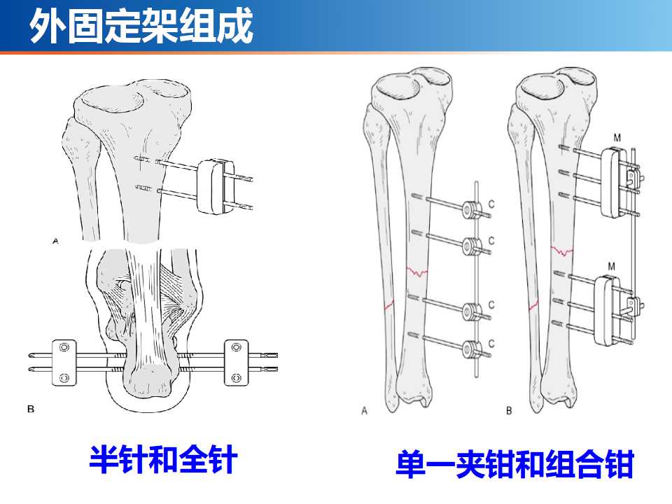 骨科常见的外固定架及其临床应用