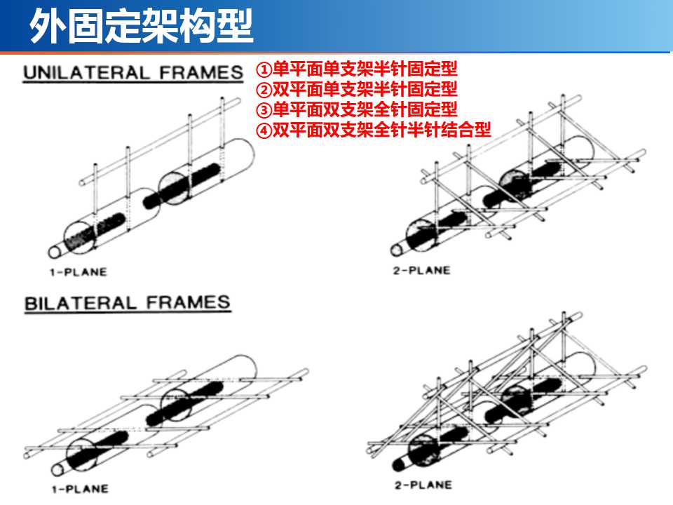 骨科常见的外固定架及其临床应用