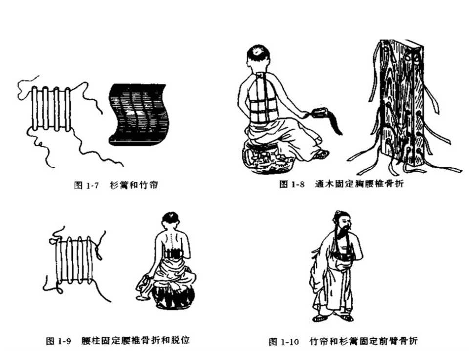 骨科常见的外固定架及其临床应用