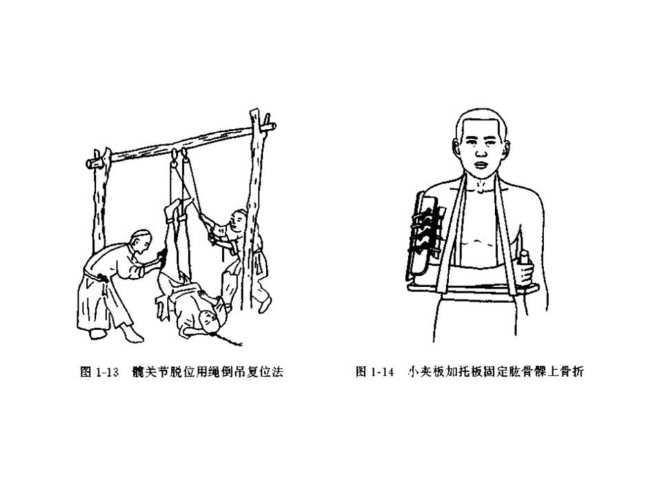 骨科常见的外固定架及其临床应用