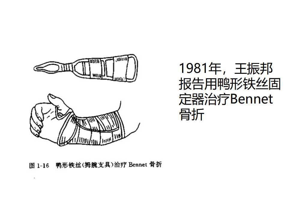 骨科常见的外固定架及其临床应用