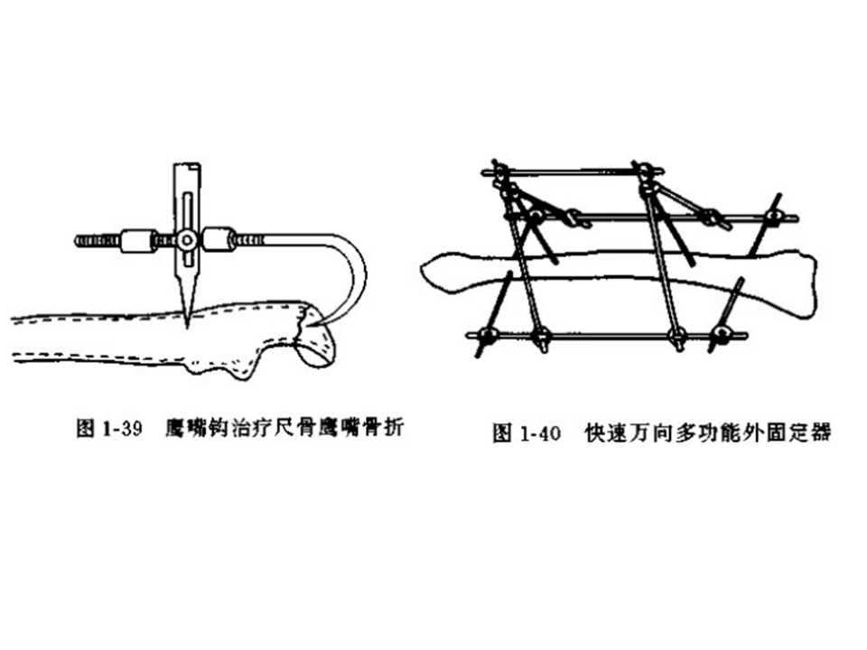 骨科常见的外固定架及其临床应用